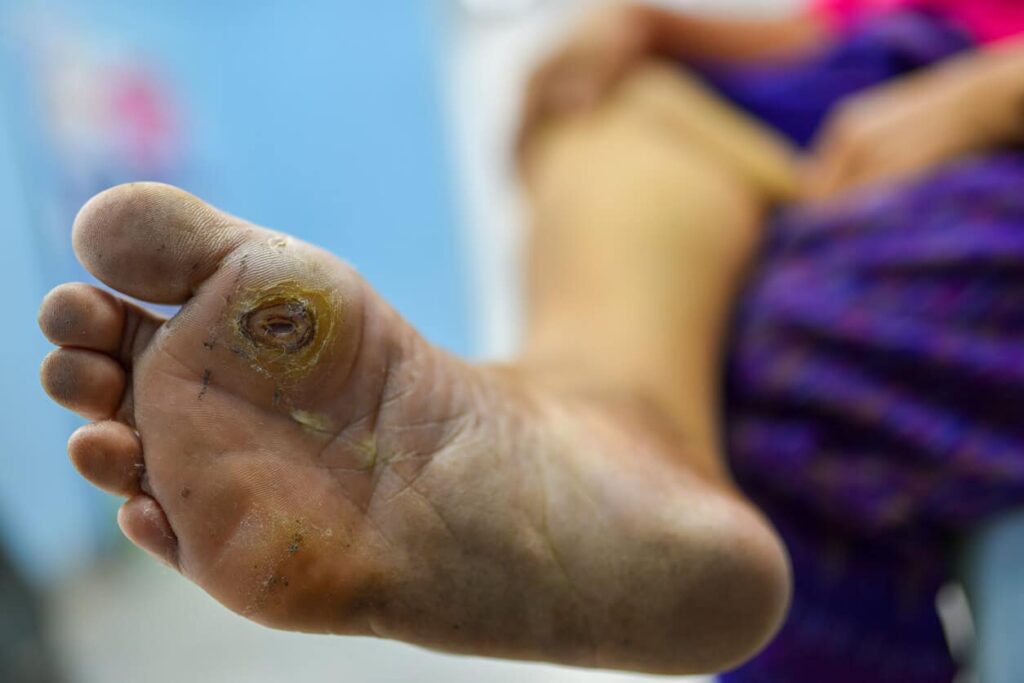 Effective Orthopedic Treatment for Diabetic Gangrene What Patients Need to Know