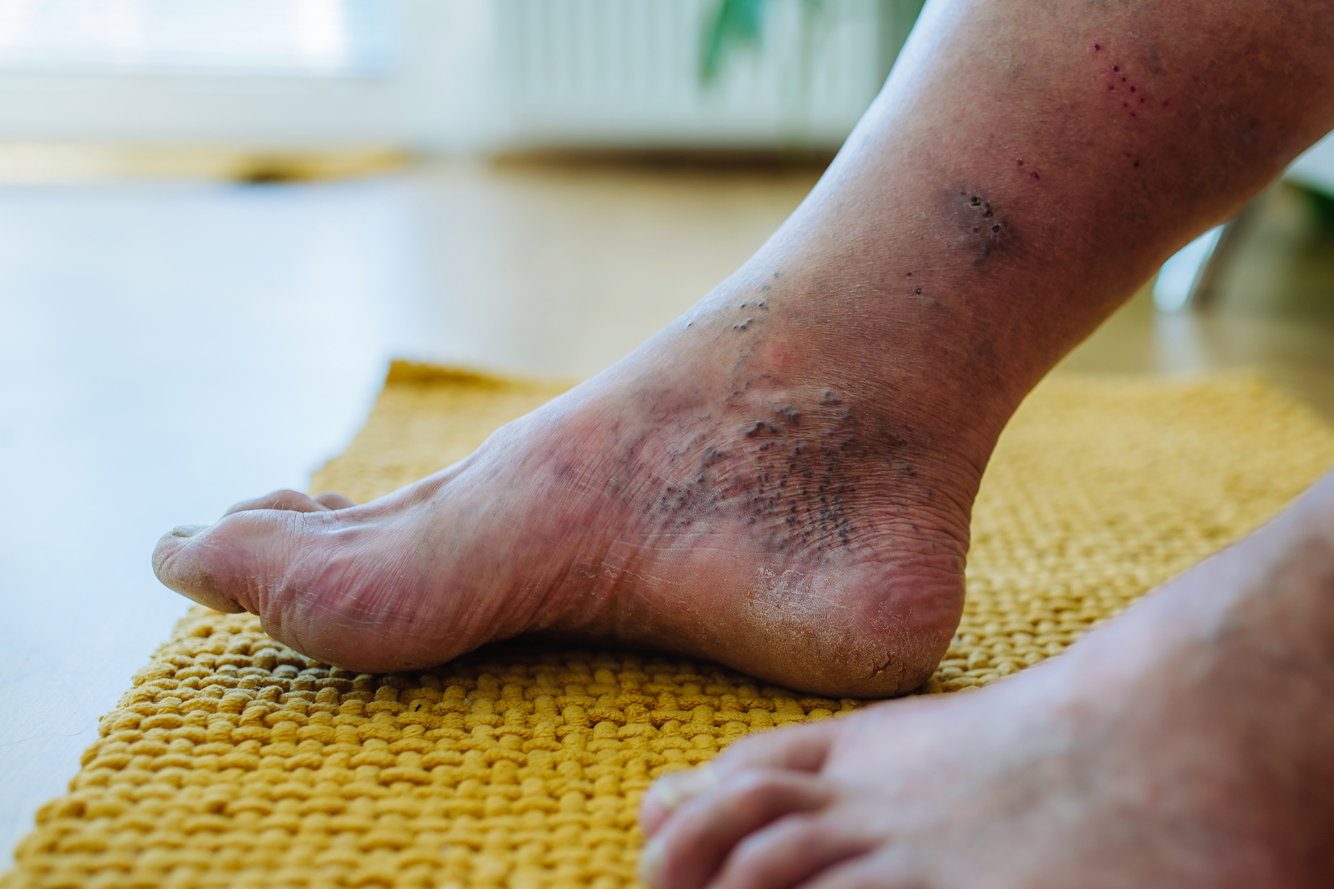 Comprehensive Diabetic Foot Ulcer Management Strategies for Prevention, Treatment, and Recovery